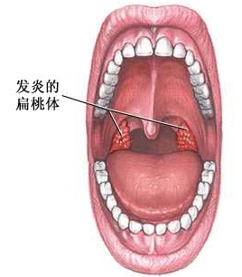 急慢性化脓性扁桃腺炎